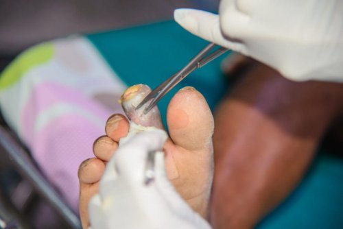 Gangrän: Formen und Behandlungsmöglichkeiten