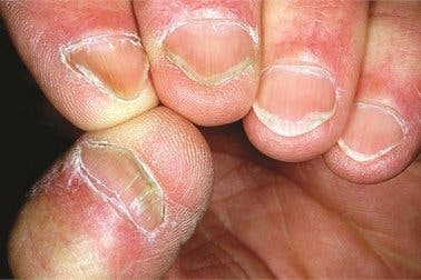 Morbus Hallopeau: Was ist das?