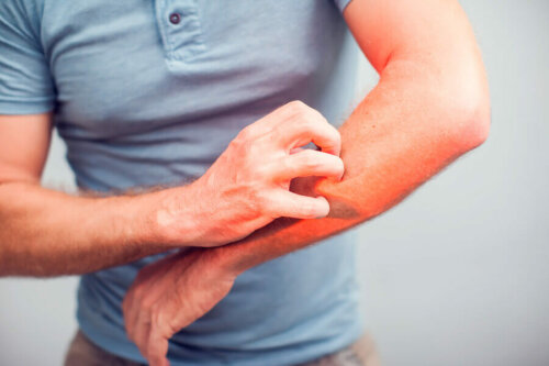 Symptome von Tungiasis