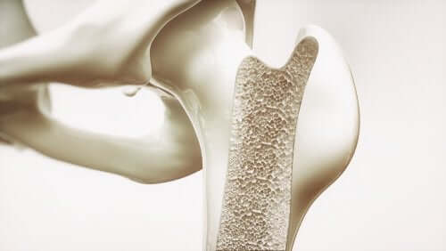 Postmenopausale Osteoporose