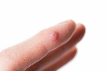 Morbus Hallopeau: Ursachen und Diagnose