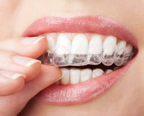 Zähne aufhellen: Vom Zahnarzt empfohlenes Bleaching zu Hause anwenden
