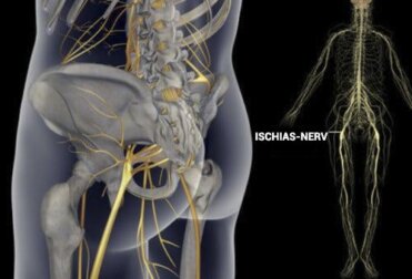 Einfache Übungen, um Ischias-Schmerzen zu lindern
