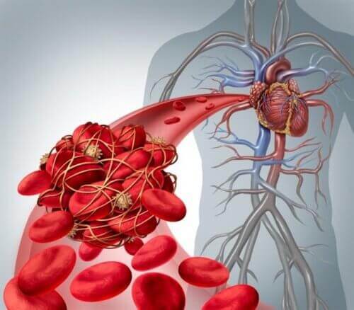 Thrombose im Herzen - Herzinfarkt