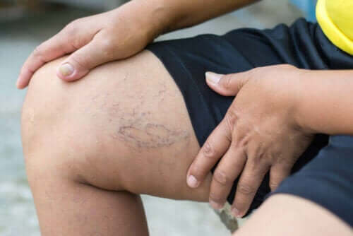 sportliche Aktivität - Krampfadern am Oberschenkel