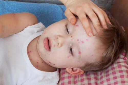 Behandlung von Nesselsucht bei Kindern