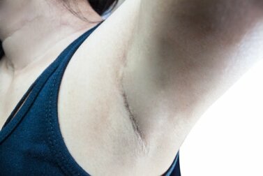 Wissenswertes über Wächterlymphknoten