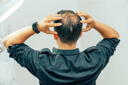 Mann mit Alopezie