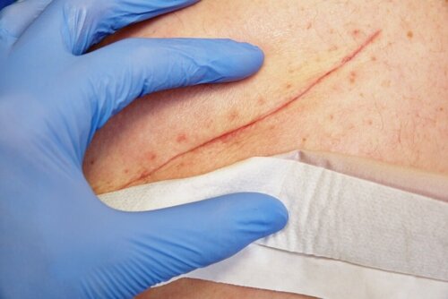 äußerliche Verwendungsmöglichkeiten von Chlorhexidin