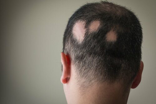 Mann mit Alopezie