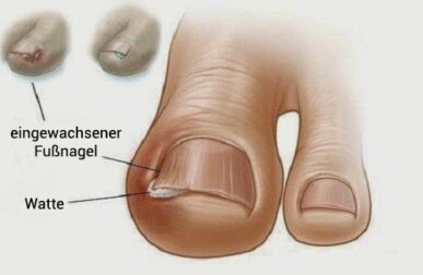 Nägel richtig schneiden und eingewachsene Fußnägel vermeiden