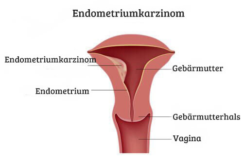 Cáncer de útero - diagrama de útero