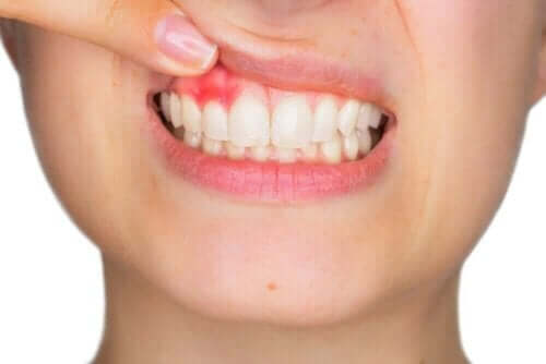 Hyaluronsäure in der Zahnheilkunde - Zahnfleischentzündung