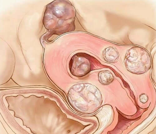 Uterusmyome - Bild