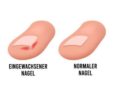 Nägel richtig schneiden - eingewachsene Fußnägel