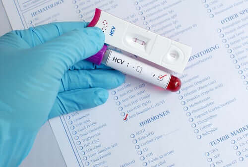Welt-Hepatitis-Tag - Hepatitistest