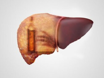 Alkoholische Hepatitis: Symptome, Ursachen und Behandlung