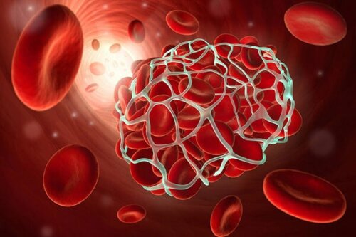 Risiko einer Thrombose durch hormonelle Kontrazeptiva
