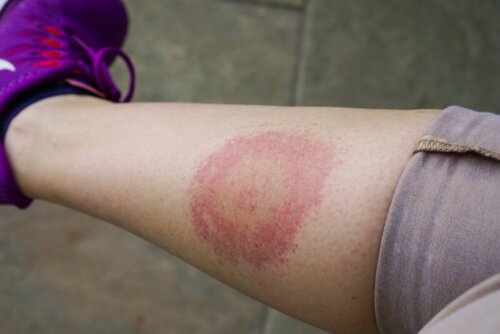 Lyme-Borreliose