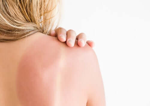 Sonnenerythem: Die besten Tipps zur Pflege der Haut