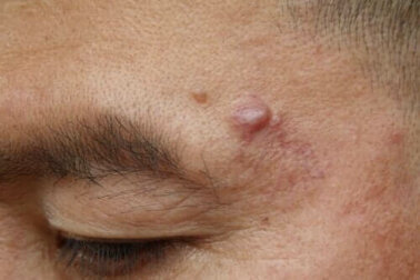 Epidermoidzysten: Ursachen und Behandlungsmöglichkeiten