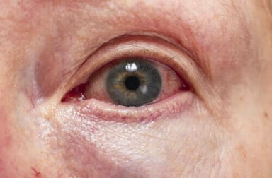 Uveitis: Diagnose und Behandlung