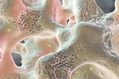 Folgen eines Kalziummangels - Osteoporose