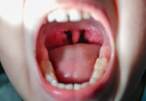 Virale Pharyngitis - offener Mund