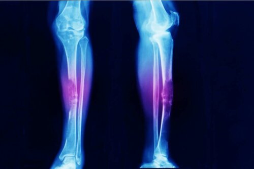 Arten von Sarkomen - Röntgenbild Unterschenkel