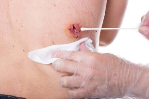 Epidermoidzysten - Behandlung einer Wunde