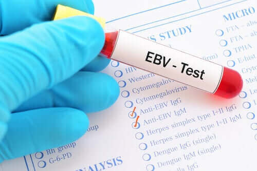 Mononukleose - EBV-Test