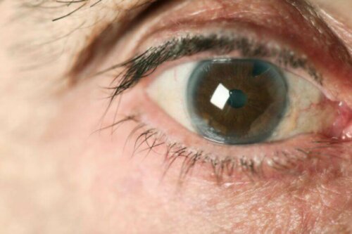 Welche Glaukomarten gibt es?