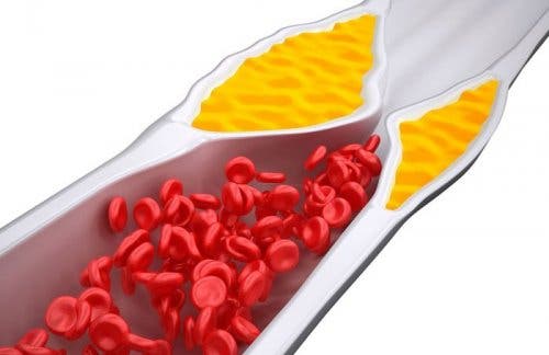 Cholesterinproblem - Schaubild Blutgefäße