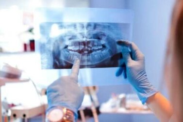 Die Kieferluxation: Ursachen und Behandlung