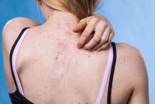 Hautausschläge: 10 Arten und ihre Symptome