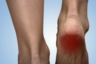 Fersensporn behandeln: 5 natürliche Heilmittel