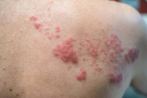 Herpes zoster ist auch als „Gürtelrose“ bekannt