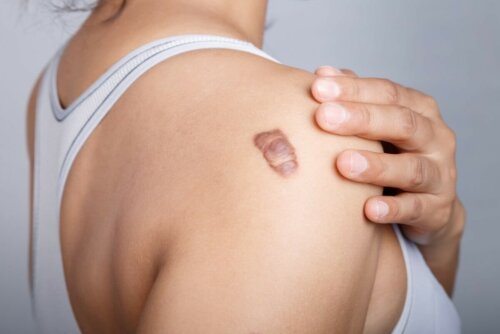 Narbe Keloid