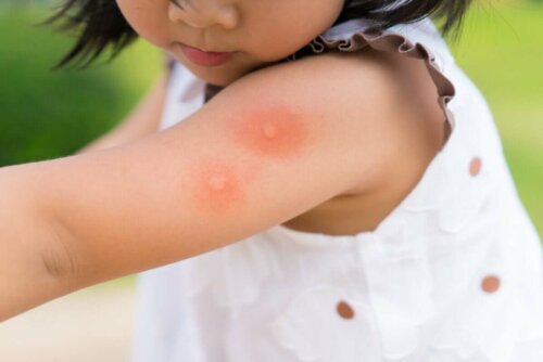 Kind mit Mückenstichen