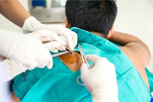 Biopsie von gutartigen Tumoren