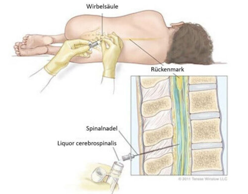 Die Lumbalpunktion ist ein klinisches Verfahren bei dem Liquor cerebrospinalis entnommen wird