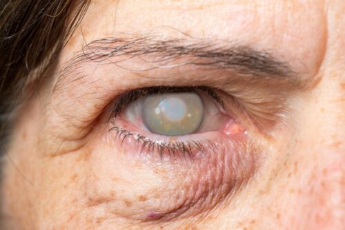 Katarakt Auge Frau Verlust des Sehvermögens