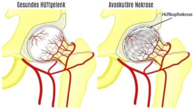 Knochennekrose des Oberschenkelknochens