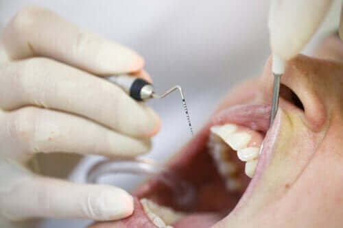 Parodontitis: Wie kommt es dazu und wie wird sie behandelt?