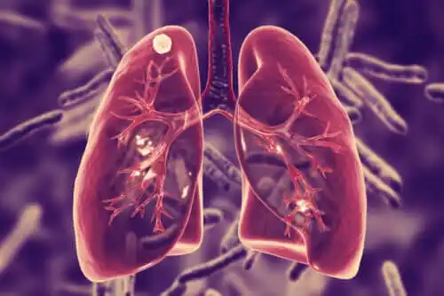 Lungentuberkulose – Ursachen und Symptome