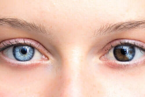 Veränderung der Augenfarbe durch Krankheiten