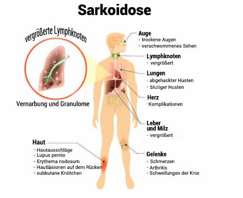 Was ist Sarkoidose? Symptome und Behandlung