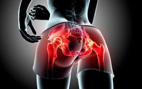gluteale Tendinopathie - Schaubild