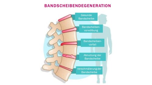 Bandscheibendegeneration: Symptome und Diagnose