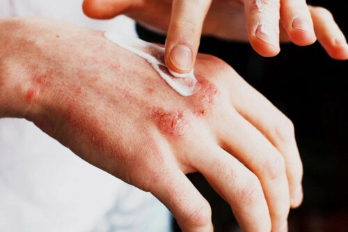 Behandlung Hautausschläge Exanthem